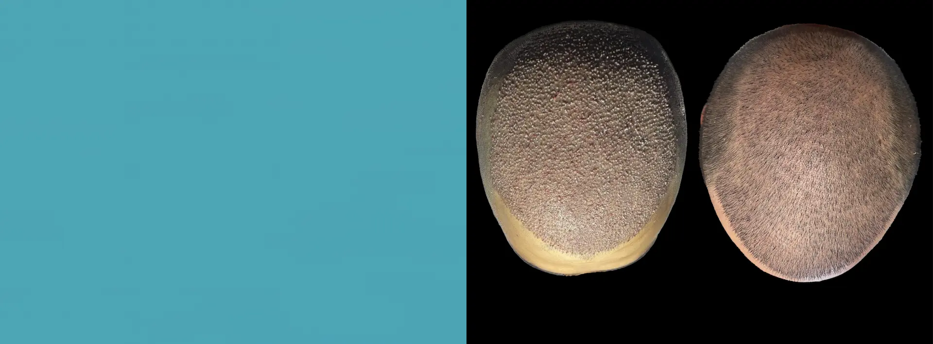 FUE Head Hair Transplant