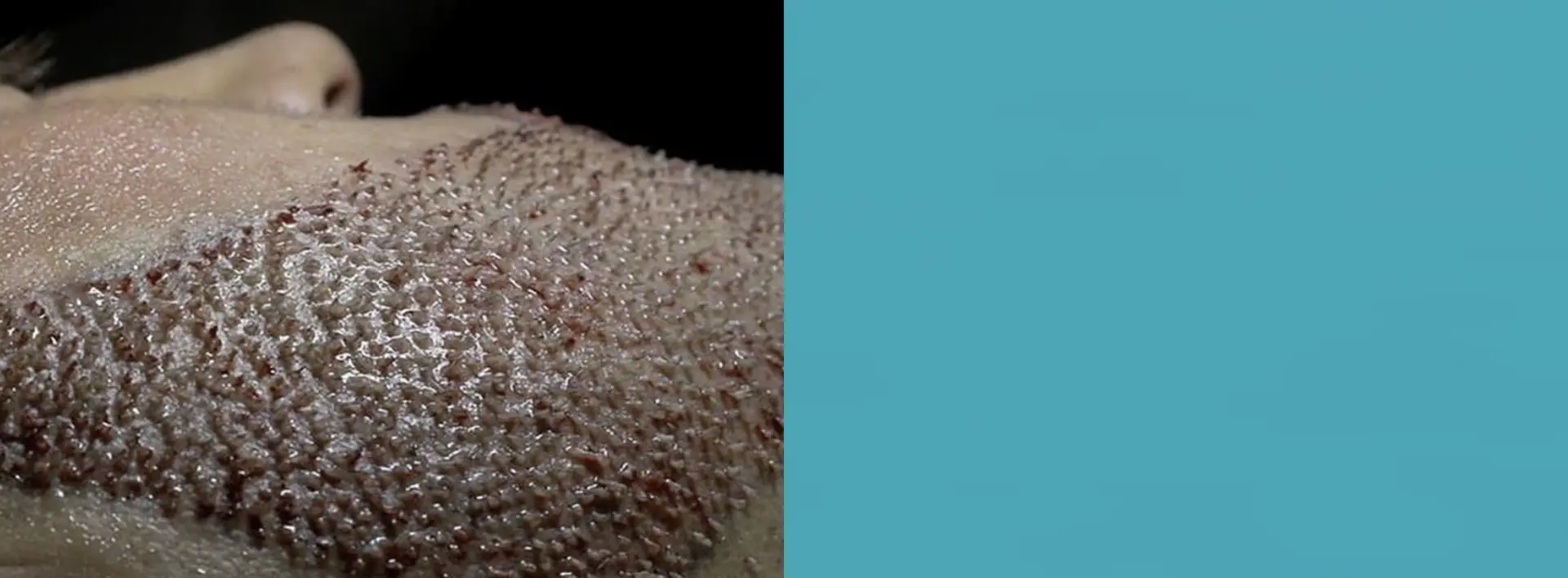 FUE Beard Hair Transplant